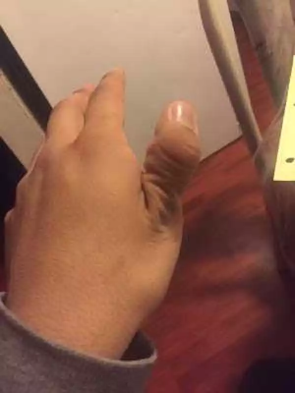 Teens are dislocating their thumbs as part of online challenge (horrifying photos)